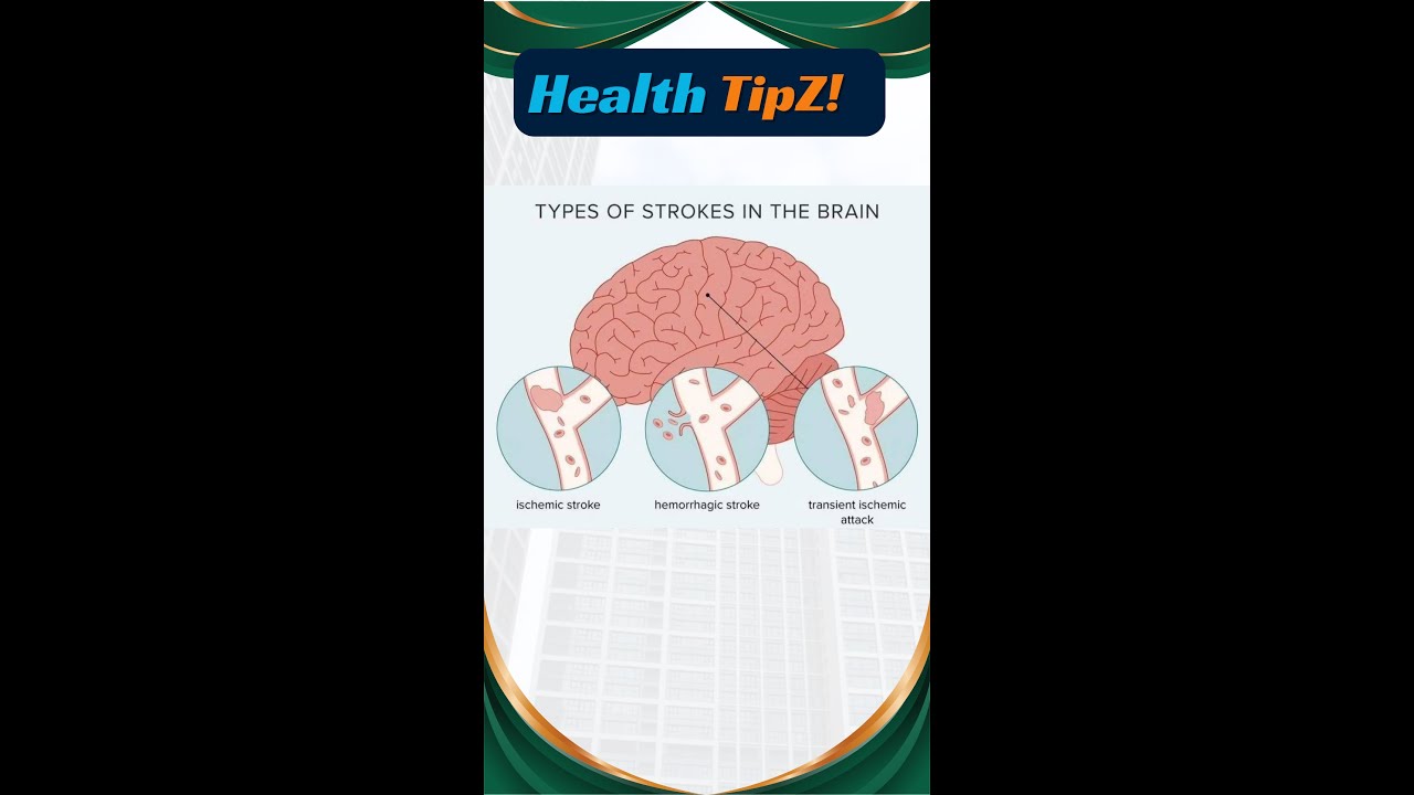 Types of stroke in brain