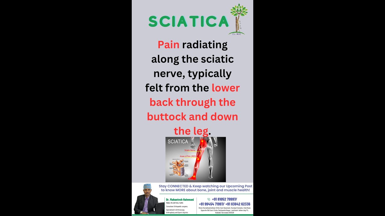 Sciatica: Pain radiating along the sciatic nerve, felt from lower back through buttock and down leg